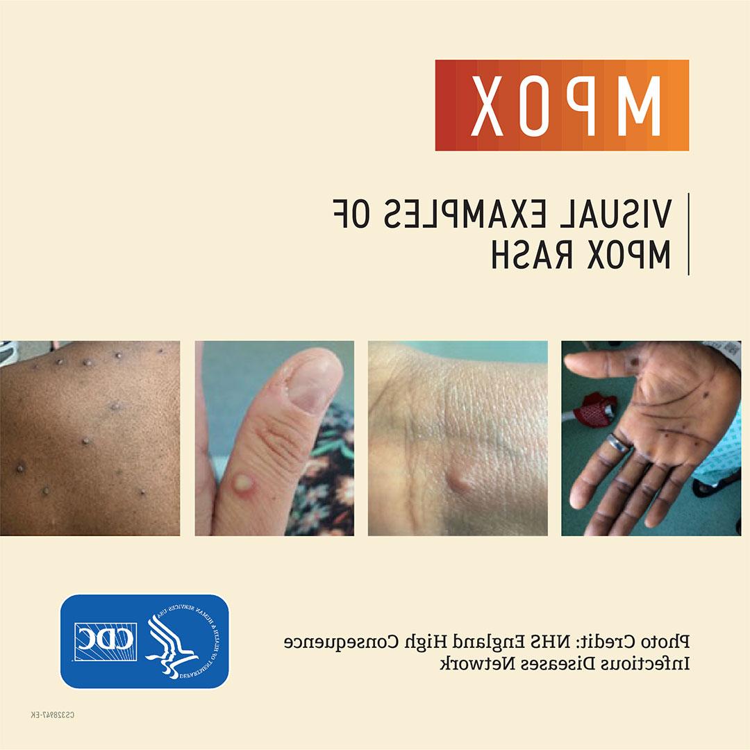 Mpox examples